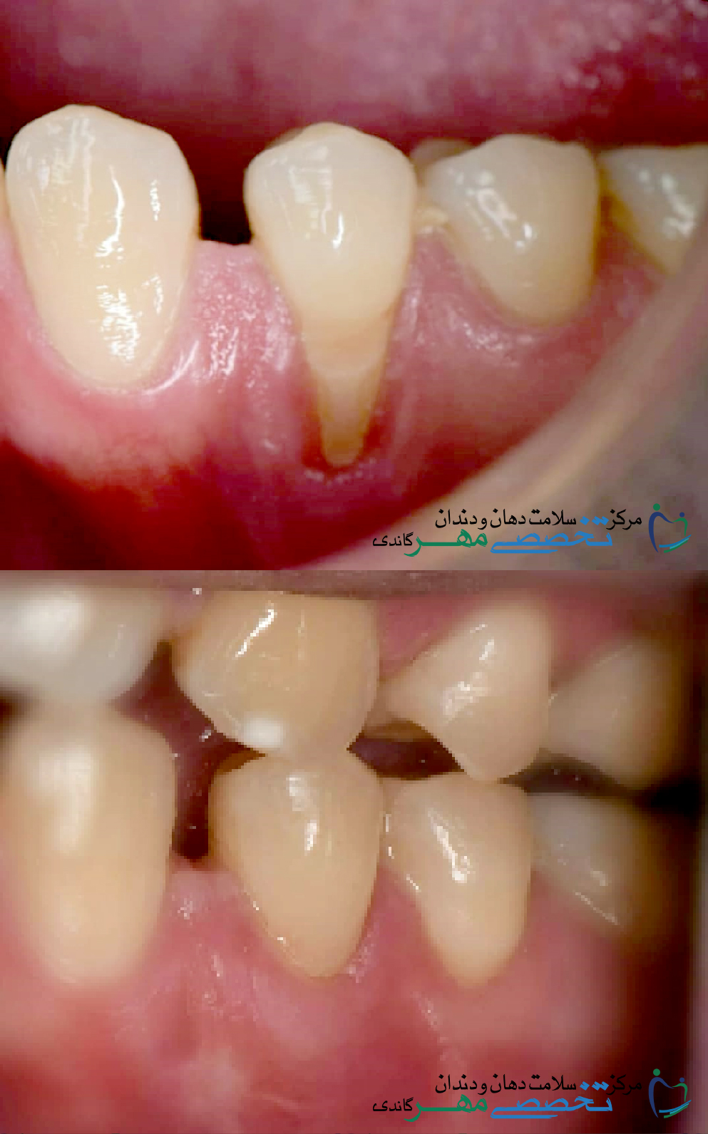 جراحی لثه - دکتر مهدی کدخدازاده 